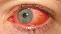 Roodheid van het oog komt mogelijk tot stand / Bron: Marco Mayer, Wikimedia Commons (CC BY-SA-4.0)